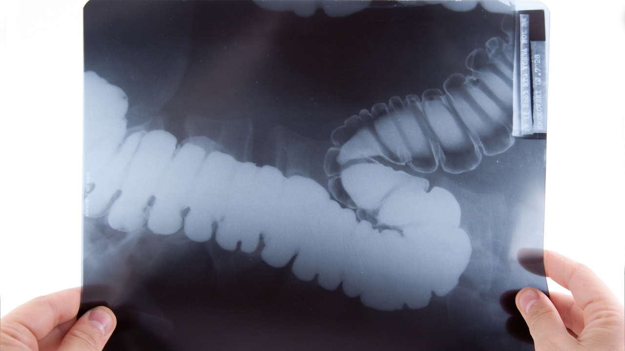 Aumento de la incidencia del cáncer colorrectal en jóvenes